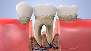 重度歯周炎の画像
